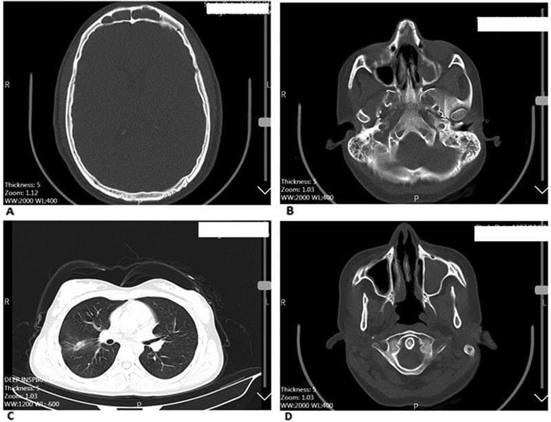 This composite of non-contrast Computed Tomography (CT) scans illustrates the multisystem manifestations of Granulomatosis with Polyangiitis (GPA), formerly known as Wegener’s granulomatosis. Panel A (axial head) shows mucosal thickening in the frontal sinuses. Panel B (axial head) reveals bilateral opacification of the maxillary sinuses and fluid within the mastoid air cells, diagnostic of bilateral sinusitis and mastoiditis. Panel C (axial chest) demonstrates pulmonary involvement characterized by focal ground-glass opacities and infiltrates in the lung parenchyma, features common in GPA-related vasculitis. Panel D (axial head) provides a detailed view of the nasal cavity showing significant destruction and perforation of the nasal septum alongside unilateral maxillary sinus opacification. These findings highlight the characteristic triad of upper respiratory tract, lower respiratory tract, and potentially renal involvement associated with this small-vessel vasculitis. The images serve as an educational tool for identifying typical radiological markers such as sinonasal destruction and pulmonary parenchymal disease.