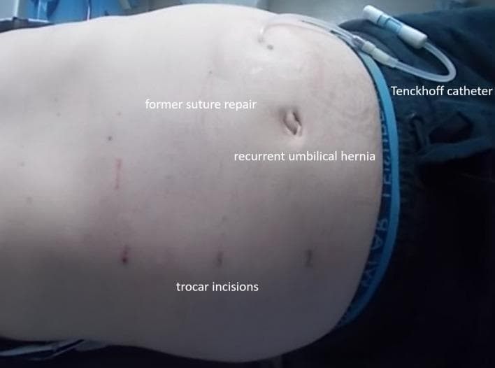 Clinical photograph of a patient's abdomen in a supine position, showing postoperative features following hernia repair and peritoneal dialysis catheter placement. In the upper right quadrant of the image, a Tenckhoff catheter is visible, exiting the abdominal wall with its external tubing and connector present. The central umbilical region displays a recurrent umbilical hernia, appearing as a slight protrusion and distortion of the umbilicus. Annotations on the skin identify a faint scar from a 'former suture repair' located superior and slightly lateral to the umbilicus. Several small, dark, punctate marks are visible across the lower abdominal wall, labeled as 'trocar incisions,' consistent with a minimally invasive or robotically-assisted surgical approach (eTEP). The image illustrates the complex abdominal wall anatomy in a patient with polycystic renal disease requiring both surgical hernia management and maintenance of peritoneal dialysis access.