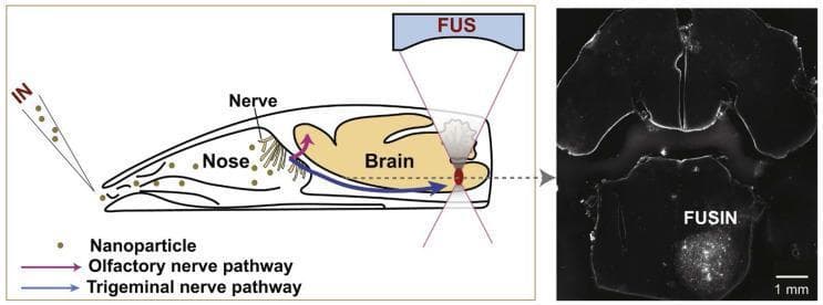 This composite image illustrates the mechanisms of nose-to-brain nanoparticle delivery. On the left is a pathophysiology diagram of a sagittal rodent head model showing intranasal (IN) administration. It depicts gold nanoparticles traversing the nasal cavity via two primary neural routes: the olfactory nerve pathway (purple arrow) and the trigeminal nerve pathway (blue arrow), bypassing the blood-brain barrier. The diagram includes a focused ultrasound (FUS) device targeting a specific intracranial region to enhance localized delivery. On the right is a diagnostic ex vivo fluorescence image (labeled 'FUSIN') showing an axial cross-section of the brainstem. The image reveals a high-intensity focal signal in the lower right quadrant, representing the successful accumulation of nanoparticles at the FUS-targeted site. A 1 mm scale bar is provided for reference. This visual material demonstrates the synergy between intranasal administration and focused ultrasound for spatially targeted central nervous system drug delivery, relevant for neuro-oncology and neurodegenerative disease research.