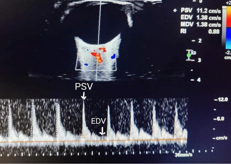 A diagnostic ultrasound image showing an ophthalmic artery spectral Doppler waveform and color Doppler flow imaging. The top panel displays a B-mode (grayscale) cross-sectional view of the eye and orbit, with a color Doppler window superimposed over the retrobulbar region to identify the ophthalmic artery; red and blue signals indicate directional blood flow. A vertical sample line passes through the vessel to generate the spectral analysis shown in the bottom panel. This pulsed-wave Doppler waveform exhibits high-resistance flow characteristic of the ophthalmic artery, featuring sharp systolic peaks labeled as Peak Systolic Velocity (PSV) and a lower End-Diastolic Velocity (EDV). Quantitative data displayed in the upper right include PSV (11.2 cm/s), EDV (1.38 cm/s), Mean Diastolic Velocity (MDV), and a Resistive Index (RI) of 0.88. This imaging is utilized in ophthalmology and obstetrics (e.g., screening for preeclampsia) to evaluate orbital hemodynamics and vascular resistance.