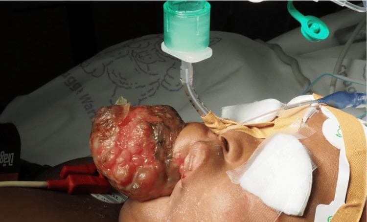 This clinical photograph shows a pediatric patient undergoing airway management for a surgical procedure. The primary pathology is a large, exophytic, and multinodular mass originating from the left facial/maxillary region. The lesion exhibits varied morphology with areas of erythema, surface ulceration, and fleshy protuberances that distort the facial anatomy. Regarding clinical intervention, the patient has been successfully intubated via the nasotracheal route. A narrow-diameter endotracheal tube is visible entering the right naris, secured with medical adhesive tape and padding. The tube is connected to a green anesthetic circuit adapter, indicating ongoing mechanical ventilation or anesthesia delivery. Monitoring equipment is evident, including electrocardiogram (ECG) leads adhered to the forehead and chest area. The image demonstrates the complexities of securing a definitive airway in a patient with significant facial pathology and highlights the importance of specialized techniques, such as videolaryngoscopy or fiberoptic-assisted intubation, in pediatric cases with anatomical distortion.
