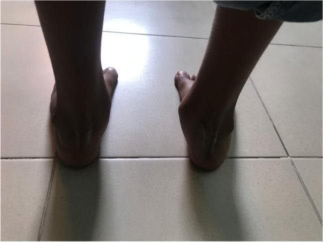 This clinical photograph shows a posterior view of both feet and ankles in a weight-bearing position on a tiled surface. The image demonstrates the post-operative results of a pediatric bilateral posteromedial release (PMR) with cuboid osteotomy. The right foot features a prominent vertical surgical scar extending over the posterior aspect of the calcaneus (heel), consistent with a Carroll surgical approach for clubfoot correction. The left foot appears relatively smooth with less visible scarring. Both heels demonstrate improved alignment from a presumed pre-operative equinovarus deformity, though the right heel shows a slightly different contour compared to the left. The feet are positioned in a neutral weight-bearing axis relative to the floor. This image is used to evaluate long-term outcomes of surgical intervention for congenital talipes equinovarus (clubfoot) in a pediatric patient, specifically focusing on skin integrity, scar formation, and hindfoot alignment.