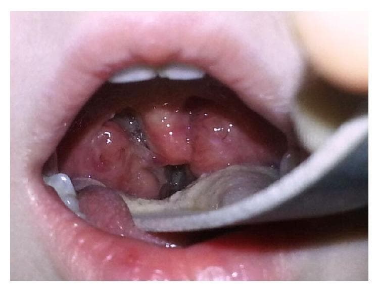 This clinical photograph displays an intraoral view of the oropharynx in a pediatric patient. The primary finding is significant bilateral palatine tonsillar hypertrophy. The tonsils appear erythematous and markedly enlarged, nearly meeting in the midline (kissing tonsils), which severely narrows the oropharyngeal airway. The surface of the tonsils is irregular and crypt-laden, with visible hyperemia and some localized white/grayish patches suggestive of either postoperative changes following radiofrequency ablation or exudative tonsillitis. A metal tongue depressor is visible in the lower right foreground, retracting the tongue to facilitate visualization of the posterior pharynx. The surrounding mucosa appears inflamed and erythematous. This image illustrates a common anatomical cause of obstructive sleep apnea (OSA) in children and serves as a teaching tool for grading tonsillar size and assessing oropharyngeal patency in an otolaryngology or primary care context.
