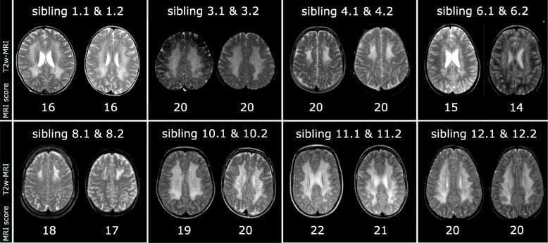 A comparison chart of T2-weighted axial MRI brain slices from eight pairs of siblings diagnosed with Metachromatic Leukodystrophy (MLD). The image demonstrates the distribution and intensity of white matter signal changes during the early stages of the disease. In each sibling pair, there is a striking visual similarity in the pattern of leukodystrophy. The affected white matter exhibits symmetric T2-hyperintensity (bright signal) compared to the relatively darker gray matter, indicating demyelination and increased water content. Spatial patterns vary between pairs, ranging from diffuse white matter involvement (e.g., pairs 3.1/3.2 and 11.1/11.2) to more regional predominance in the frontal and parietal-occipital areas (e.g., pairs 4.1/4.2 and 12.1/12.2). Below each scan, numerical MRI scores are provided, highlighting the closely matched disease severity within each sibling pair. This clinical imaging set serves as an educational tool for recognizing the characteristic 'butterfly' or confluent hyperintense patterns of pediatric leukodystrophies and the high phenotypic concordance in familial cases.