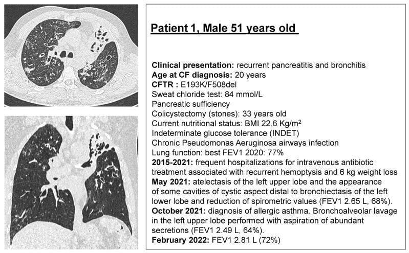 This composite educational graphic features diagnostic imaging and a clinical summary for a 51-year-old male with cystic fibrosis (CFTR genotype E193K/F508del). On the left, axial and coronal CT pulmonary scan slices demonstrate advanced respiratory pathology. Visible features include diffuse, bilateral bronchiectasis characterized by bronchial wall thickening and luminal dilation. Notably, the left upper lobe shows signs of significant atelectasis and volume loss, while the left lower lobe displays cystic cavities distal to the bronchiectatic airways. Heterogeneous lung density suggests areas of chronic inflammation and mucus plugging. The right panel provides a detailed clinical timeline and physiological data, including a sweat chloride test of 84 mmol/L, pancreatic sufficiency status, and chronic Pseudomonas aeruginosa infection. It tracks a longitudinal decline in lung function, noting an FEV1 decrease to 64–72% alongside episodes of recurrent hemoptysis and significant weight loss. This visual material serves as an educational case study on the radiological progression and clinical manifestation of specific CFTR mutations in adult patients.