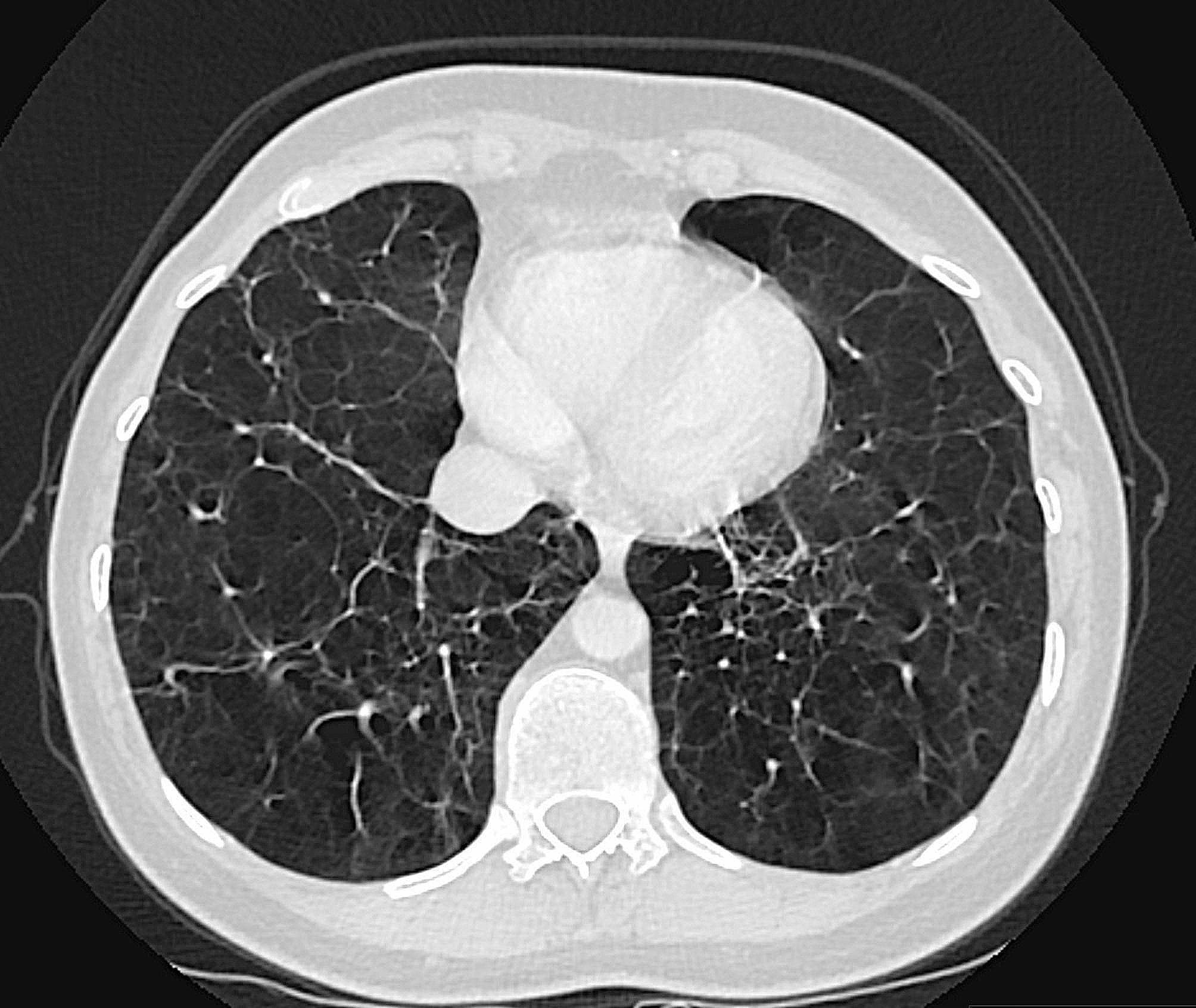 This diagnostic image is a transverse (axial) CT scan of the thorax, specifically focusing on the pulmonary parenchyma in a lung window. The imaging reveals widespread, severe emphysematous changes characterized by diffuse areas of abnormally low attenuation (lucency) and rarefaction of the lung tissue. The findings include both centriacinar and panacinar emphysema patterns, leading to significant destruction of the alveolar walls and a visible reduction in normal vascular markings. These changes are particularly pronounced in the lower lobes, manifesting as large, confluent areas of air entrapment and parenchymal volume loss. Additionally, localized regions of increased density suggest secondary features such as atelectasis or underlying fibrosis, and tractional bronchiectasis is evident within the distorted lung architecture. Clinically, this pattern of basilar-predominant emphysema is a hallmark radiological finding of alpha-1 antitrypsin deficiency (AATD), demonstrating the progressive lung destruction associated with this genetic protease-antiprotease imbalance.