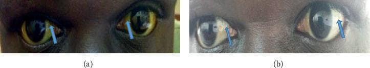 Clinical photograph comparison of a patient's eyes demonstrating the resolution of jaundice. Panel (a) shows bilateral scleral icterus, characterized by a distinct yellowing of the sclera and bulbar conjunctiva, marked with blue arrows. This appearance is secondary to hyperbilirubinemia often associated with hepatobiliary disease. Panel (b) shows the same patient after two weeks of treatment, demonstrating a marked reduction in the yellow hue. The sclera has returned to a near-normal white color, indicating a decrease in systemic bilirubin levels and successful therapeutic intervention. This side-by-side comparison serves as an educational tool for identifying physical signs of liver dysfunction and monitoring clinical progression during treatment.