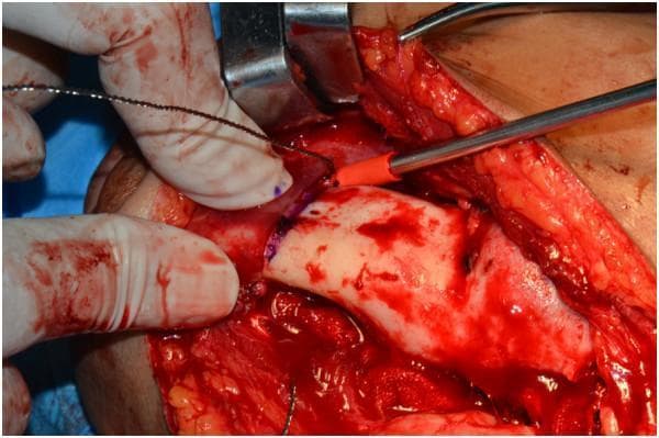 This clinical photograph captures an intraoperative view of a mandibular osteotomy procedure, a critical step in maxillofacial reconstruction or tumor resection (e.g., for ameloblastoma). The surgical field shows the exposed mandible with distinct purple ink markings on the cortical bone surface, indicating the planned osteotomy line derived from a preoperative rapid prototyping (RP) template. A surgical Gigli saw is visible on the left, positioned to initiate the bone cut along the marked path. An orange-tipped surgical instrument is also seen being applied to the inferior border of the mandible to assist in stabilization or guidance. The surrounding soft tissue is retracted, showing the submandibular surgical approach and the blood-stained operative site. This image demonstrates the clinical application of computer-aided surgical planning and template-guided osteotomy to ensure high precision in mandibular resection, facilitating accurate subsequent reconstruction with bone grafts.