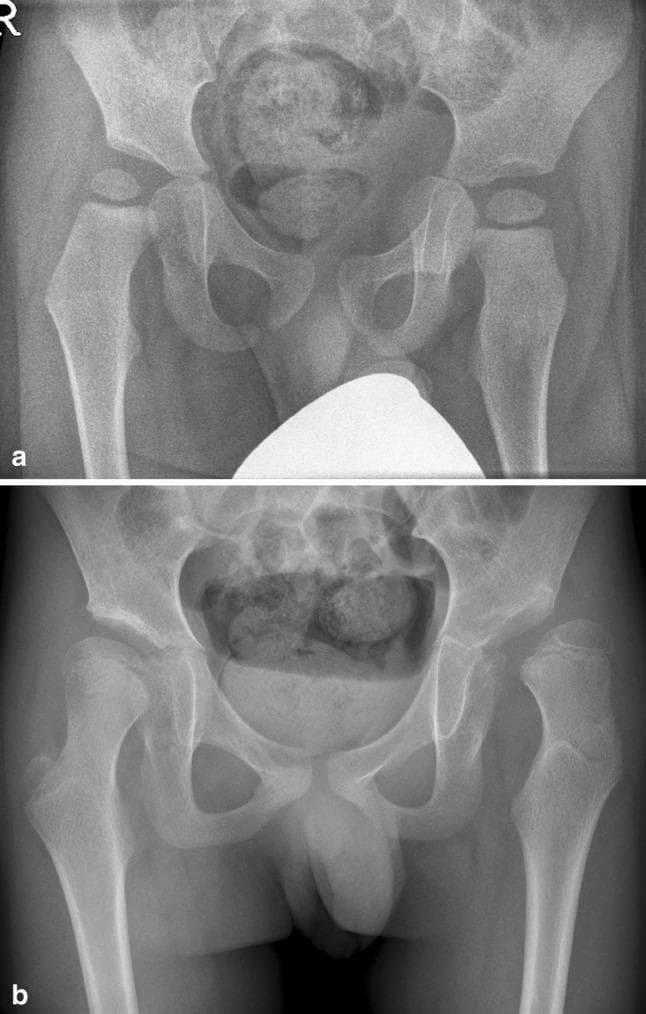 Two anteroposterior (AP) pelvic radiographs demonstrating the longitudinal progression of hip displacement in a pediatric patient with Gross Motor Function Classification System (GMFCS) level V cerebral palsy. Figure (a) shows the initial state at 22 months, where the right femoral head exhibits early subluxation with 29% migration, while the left remains seated. Figure (b) displays the same patient at 95 months (nearly 8 years), illustrating significant disease progression. Both hips show increased coxa valga, with the right hip progressing to 34% migration and the left hip reaching 76% migration, indicating severe lateral displacement and loss of acetabular coverage. The image serves as a clinical example of how high head-shaft angles (HSA) and neuromuscular imbalances contribute to progressive hip luxation over time in non-ambulatory patients. Key diagnostic features visible include the increasing lateral migration of the femoral epiphyses relative to Perkins' line and the persistent vertical orientation of the femoral necks.