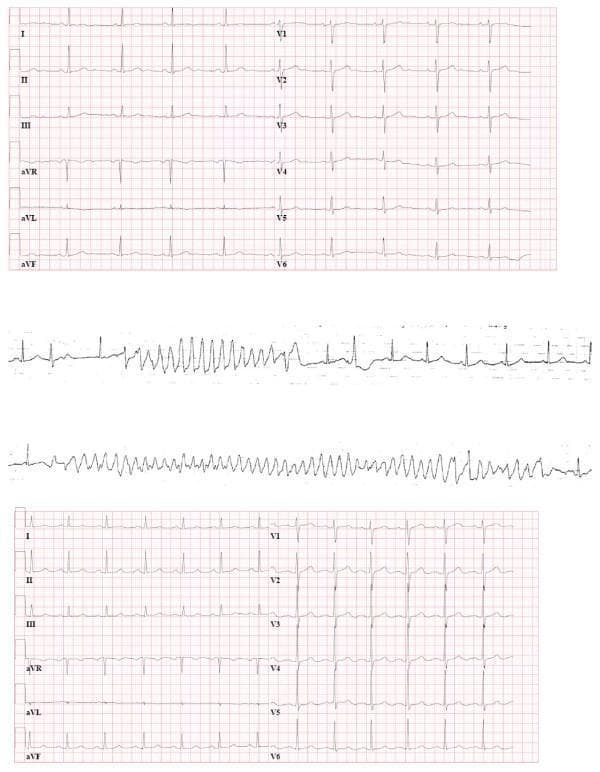This composite educational graphic presents three sets of electrocardiogram (ECG) recordings demonstrating the progression of cardiac rhythm disturbances in a perioperative clinical context. Panel A (top) shows a standard 12-lead preoperative ECG displaying normal sinus rhythm (58 bpm) with a normal corrected QT interval (QTc 440 ms). Panel B (middle) provides rhythm strips exhibiting Torsades de Pointes (TdP), a polymorphic ventricular tachycardia. The upper strip in this panel clearly illustrates the 'short-long-short' sequence of R-R intervals preceding the initiation of the arrhythmia. The tachycardia itself shows the classic 'twisting of the points' morphology where the QRS axis and amplitude continuously shift around the isoelectric line. Panel C (bottom) shows a postoperative 12-lead ECG demonstrating sinus rhythm (77 bpm) with significant pathological QT prolongation (QTc 505 ms), particularly prominent in lead aVF. This panel also shows newly developed U waves merging into the preceding P waves in precordial leads V1-V4. The image serves as a clinical teaching tool for recognizing high-risk ECG features for malignant arrhythmias and the characteristic morphology of drug-induced or catecholamine-induced Torsades de Pointes.