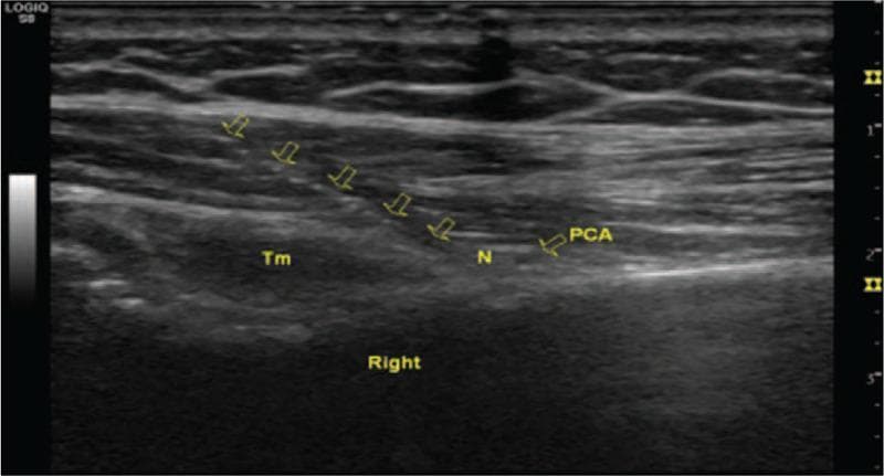 This musculoskeletal ultrasound image displays the neurovascular anatomy of the quadrangular space, captured during a guided axillary nerve block procedure. The image is a cross-sectional view showing three primary structures of interest: the teres minor (Tm), the axillary nerve (N), and the posterior humeral circumflex artery (PCA). The teres minor muscle is visible as a relatively hypoechoic, striated structure on the left. Medial to the muscle, the axillary nerve (N) appears as a small, rounded, hypoechoic structure. Immediately adjacent to the nerve is the posterior humeral circumflex artery (PCA), visualized as an anechoic tubular structure. Yellow arrows indicate the needle trajectory or the fascial plane used for the nerve block. This diagnostic image illustrates the close anatomical relationship between these structures, which is critical for diagnosing quadrilateral space syndrome and performing safe regional anesthesia. The imaging demonstrates the typical echogenicity of peripheral nerves and vascular structures in the posterior shoulder region.