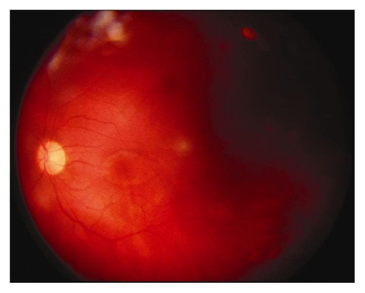 A color fundus photograph of a human eye demonstrating acute clinical features of endophthalmitis. The image shows significant vitreous haze (vitritis), which markedly reduces the clarity of the retinal details. The optic disc is visible as a yellowish-white structure, but its margins appear blurred. The retinal background exhibits a diffuse, deep reddish hue, indicative of severe inflammation and congestion. Key pathological findings include multifocal white retinal infiltrates scattered throughout the posterior pole and visible retinal hemorrhages, particularly in the superior peripheral quadrant. The retinal vasculature is partially obscured by inflammatory exudates and the hazy vitreous media. This image serves as an educational example of the funduscopic presentation of severe intraocular infection, often following penetrating trauma or surgery, where inflammatory debris prevents a sharp view of the underlying retina.