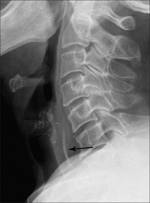 This lateral neck radiograph (X-ray) displays the cervical spine from the C2 level through the upper thoracic vertebrae. The primary finding is a linear, radiopaque foreign body situated vertically within the hypopharyngeal region, specifically localized at the level of the C5-C6 vertebrae (indicated by a black arrow). The foreign body exhibits a calcific density, appearing more radiopaque than the adjacent soft tissues but less dense than the vertebral bodies. Importantly, the prevertebral soft tissue space appears normal in width with no evidence of prevertebral thickening or retropharyngeal air (emphysema), which are common secondary signs of esophageal or pharyngeal injury. The radiograph serves as a diagnostic tool for identifying radiopaque ingested foreign bodies in the upper aerodigestive tract. The educational focus is on the anatomical localization of foreign objects and the assessment of associated soft tissue complications in emergency or otolaryngological clinical scenarios.