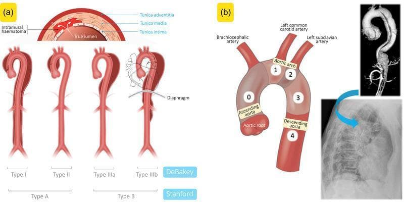 Educational medical composite illustrating the classification and diagnostic imaging of aortic dissections. Panel (a) presents a pathophysiology diagram showing an intimal tear and the formation of true and false lumens, alongside the DeBakey and Stanford classification systems. DeBakey Type I involves the ascending aorta, arch, and descending aorta; Type II is confined to the ascending aorta (both Stanford Type A). Type IIIa is limited to the descending thoracic aorta above the diaphragm, while Type IIIb extends below the diaphragm (both Stanford Type B). Panel (b) features an anatomical diagram of the aortic arch divided into surgical zones 0-4, identifying the brachiocephalic, left common carotid, and left subclavian arteries. Included diagnostic images show a 3D magnetic resonance angiography (MRA) reconstruction of a Type B aortic dissection and a corresponding lateral chest X-ray illustrating endovascular repair with a stent graft. This resource is designed for cardiovascular medical education, specifically for teaching the anatomical extent and management triage of acute aortic syndromes.