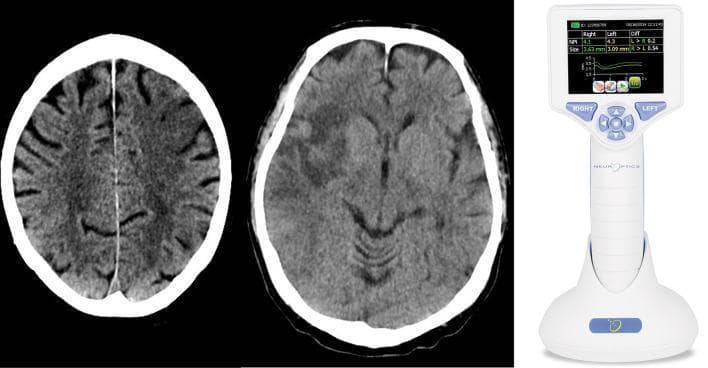 This composite educational image illustrates the clinical assessment of stroke patients using neuroimaging and automated pupillometry. On the left and center are two axial non-contrast CT scans of the brain. The left image demonstrates a hypodense area in the left prefrontal region, consistent with an ischemic infarction in the prefrontal eye field. The center image shows a larger area of hypodensity involving the right insular cortex and surrounding white matter, characteristic of a strategic stroke in an autonomic control center. On the right, a clinical photograph displays a handheld automated pupillometer (NeurOptics NPi-200). The device's digital interface displays quantitative data for both eyes, including the Neurological Pupil index (NPi) and pupil size in millimeters, alongside a pupillary light reflex waveform. This visual combination demonstrates the integration of anatomical diagnostic imaging with functional neurological monitoring in acute stroke management.