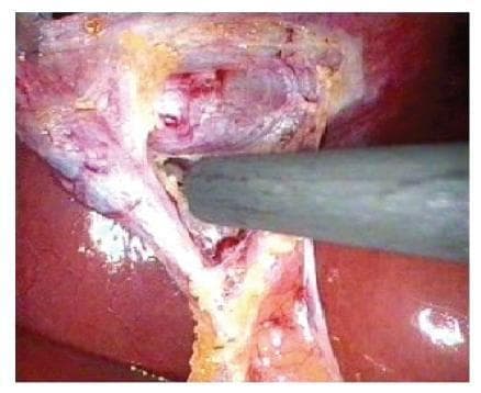 Laparoscopic intraoperative photograph showing the dissection of the Triangle of Safety during a cholecystectomy. The image displays the inferior surface of the liver (reddish-brown parenchyma) and the retracted gallbladder. A laparoscopic dissecting instrument is actively manipulating and dividing connective tissues within the triangle, which is bordered by the cystic duct, the cystic artery/gallbladder wall, and the liver bed. Visible features include glistening peritoneal surfaces, yellow fatty tissue along the gallbladder wall, and the initial exposure of the cystic duct-infundibular junction. This clinical visual demonstrates the 'top-down' or fundus-first dissection technique where the surgeon clears tissues close to the gallbladder wall to achieve the critical view of safety, thereby avoiding injury to the common bile duct and other vital structures in Calot's triangle.