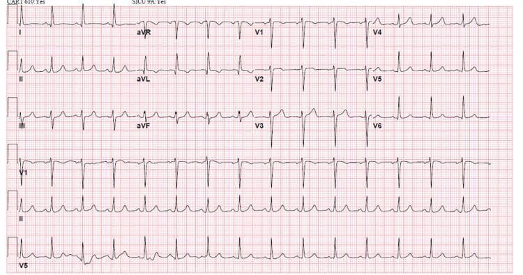 This diagnostic image is a standard 12-lead electrocardiogram (EKG) demonstrating a normal sinus rhythm in a patient following treatment for hyperkalemia. The tracing shows regular P waves that are upright in leads I, II, and aVF, with each P wave followed by a narrow QRS complex (duration <120 ms). The PR interval is within normal limits. The QRS complexes exhibit normal morphology across all limb and precordial leads (V1-V6), with a normal R-wave progression. T waves are concordant and lack the peaked morphology characteristic of acute hyperkalemia. No significant ST-segment deviations or pathological Q waves are visible. The clinical significance of this EKG is to demonstrate the resolution of conduction abnormalities, such as left bundle branch block (LBBB) or QRS widening, typically seen in severe electrolyte imbalances like hyperkalemia, after successful intervention with hemodialysis and medical management.