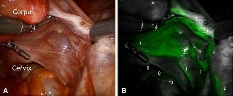 This dual-panel image displays an intraoperative laparoscopic view of the right posterior female pelvis during an indocyanine green (ICG) fluorescence lymphography procedure. Panel A is a standard white-light endoscopic photograph showing the corpus uteri, cervix, and the associated mesometrial and mesonephric compartments. Panel B shows the corresponding near-infrared fluorescence image. In Panel B, intense green ICG fluorescence is localized within the Müllerian lymphatic mesometrial network and the collecting lymph vessels of the vascular mesometrium. These pathways are labeled to indicate drainage toward the pelvic lymph nodes (1) and paraaortic lymph nodes (2). A significant negative finding is the complete absence of fluorescence (0) along the ligamentous mesometrium (uterosacral ligament region), demonstrating that the corporal uterine sub-compartment does not drain through this specific anatomical pathway. This visual comparison illustrates the compartmentalization of lymphatic drainage in gynecologic oncology, differentiating between vascular and ligamentous pathways for surgical mapping.