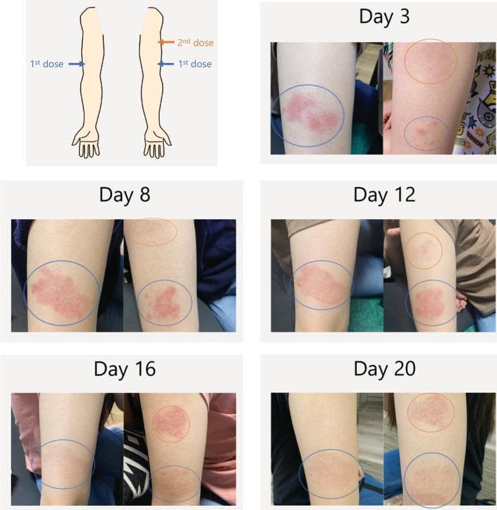 This clinical photographic sequence illustrates a timeline of a delayed cutaneous hypersensitivity reaction at injection sites following the administration of the biologic agent dupilumab. The material consists of an anatomical diagram indicating injection sites and a series of photographs from Day 3 to Day 20. The first dose site (blue circle) shows an erythematous, well-demarcated plaque that peaks in intensity and texture at Day 8 before gradually fading by Day 20. The second dose site (orange circle) exhibits a similar localized inflammatory response that develops later, peaking around Day 16. This progression demonstrates a classic delayed-type hypersensitivity reaction, potentially related to excipients like polysorbate 80. The image provides a clinical reference for monitoring drug-induced skin eruptions and distinguishes between immediate and delayed cutaneous adverse events in immunology and dermatology. It is suitable for medical education regarding the side effect profile of monoclonal antibodies.