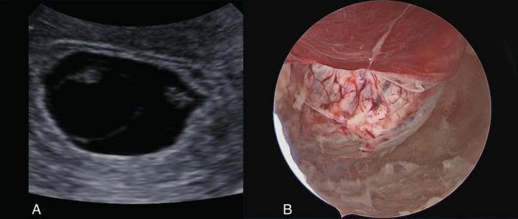This composite clinical figure demonstrates a missed miscarriage through two distinct imaging modalities: transvaginal ultrasound and operative hysteroscopy. Panel A shows a transvaginal ultrasound image of a gestational sac (GS) appearing as a large, anechoic (black) fluid-filled structure with a prominent hyperechoic (white) decidual rim. Within the sac, irregular fetal poles or embryonic echoes are visible without cardiac activity, consistent with a missed abortion. Panel B displays a hysteroscopic view of the same gestational sac within the uterine cavity. The sac presents as a reddish, translucent, vascularized membrane with visible branching blood vessels. The surrounding endometrium is pinkish-tan, and thin, whitish fibrinous strands or tissue remnants are seen associated with the surface of the sac. This clinical photograph illustrates the preoperative findings of a monochorionic pregnancy failure, highlighting the correlation between radiological and direct visual anatomy in obstetric pathology.