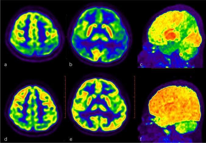 This diagnostic comparison contains six 18F-FDG PET/CT brain scans from a pediatric patient, organized in two rows to demonstrate disease progression and treatment response in autoimmune encephalitis (AE). The upper row (a, b: axial slices; c: sagittal MIP map) shows baseline metabolic activity with prominent, large-scale cortical hypometabolism (blue/green areas) in the bilateral parietal, temporal, and frontal lobes. In contrast, focal hypermetabolism (red/orange) is visible in the basal ganglia. The bottom row (d, e: axial slices; f: sagittal MIP map) represents a follow-up scan 2.5 months post-immunotherapy. These images reveal a significant metabolic recovery, characterized by the resolution of previous hypometabolism and a more homogeneous, physiological distribution of tracer uptake across the cortex (yellow/orange). The comparison illustrates the utility of FDG-PET in monitoring therapeutic efficacy and clinical improvement in pediatric autoimmune neurological conditions.