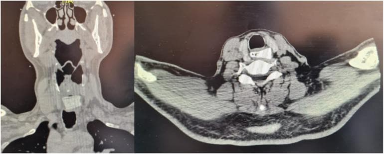 This diagnostic image displays a non-contrast CT scan of the neck in two planes: coronal (left) and axial (right). The primary pathology is a radiopaque, rectangular foreign body approximately 20 x 25 mm lodged within the cervical esophagus. In the coronal view, the high-density object is positioned inferior to the laryngeal structures and hyoid bone, within the upper third of the esophagus. In the axial view, the foreign body is clearly visualized posteriorly to the trachea and anteriorly to the vertebral body, demonstrating its intraluminal position in the esophageal space. Key anatomical landmarks visible include the mandible, cervical vertebrae, trachea with its air-filled lumen, and surrounding soft tissues. This imaging is clinically significant for diagnosing esophageal foreign body obstruction and assessing for complications such as perforation or deviation of adjacent structures. It serves as an educational example of radiological identification of non-biologic esophageal foreign bodies in an emergency or surgical context.