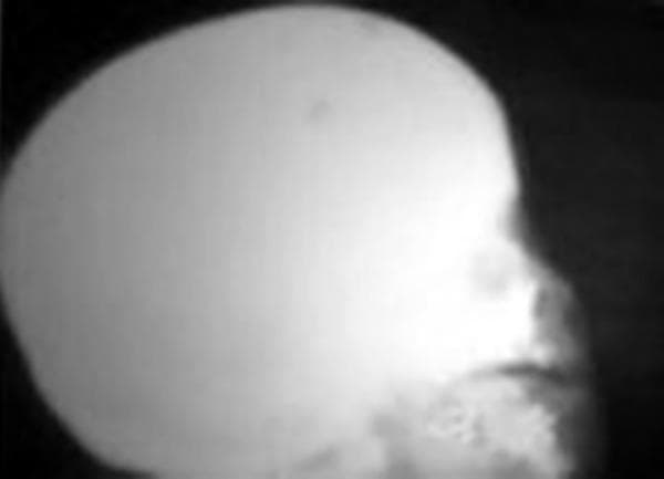 This lateral skull radiograph demonstrates a marked, generalized increase in bone density, characterized by a homogenous radio-opacity throughout the cranial vault and facial skeleton. This 'bone-within-bone' or 'chalk-like' appearance is a classic hallmark of osteopetrosis (Albers-Schönberg disease). The diffuse sclerosis obscures normal anatomical landmarks, including the distinction between the inner and outer tables of the skull, the diploic space, and the paranasal sinuses. The maxilla and mandible also exhibit significant thickening and hyperdensity, which contributes to the poor visualization of developing dental structures and an apparent limitation in alveolar ridge development. Clinically, such findings in a pediatric patient are significant for impaired bone remodeling, which can lead to complications such as cranial nerve compression (resulting in vision or hearing loss) and a predisposition to osteomyelitis due to reduced vascularity.