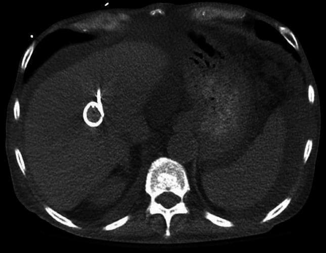 This diagnostic image is an axial computed tomography (CT) scan of the upper abdomen, specifically focused on the liver. The scan reveals a large, ill-defined, hypodense lesion within the right lobe of the liver, consistent with a hepatic abscess. Centered within this fluid collection is a highly radiopaque, pigtail-shaped structure, identifying a percutaneous drainage catheter (drain) placed for therapeutic intervention. The surrounding liver parenchyma appears otherwise unremarkable in density. Posteriorly, the vertebral body and neural arch are visible as hyperdense (bright white) bony structures. The rib cage is partially visualized at the periphery of the abdominal cavity. Subcutaneous fat is seen as a low-density (dark gray) layer beneath the skin. This image serves as a clinical example of radiographic monitoring for image-guided drainage of complex intra-abdominal infections, such as those caused by vancomycin-resistant Enterococcus (VRE) or other multidrug-resistant organisms.