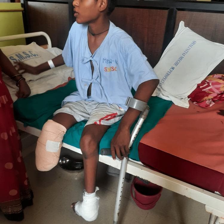 A clinical photograph of a pediatric or adolescent patient seated on a hospital bed, demonstrating post-operative management of the lower extremities. The right leg displays a below-knee amputation (transtibial) with a residual limb (stump) that is wrapped in a beige compression bandage secured with white tape, typical for post-surgical shaping and edema control. The left foot and ankle are encased in a white medical bandage or light cast, consistent with a post-operative state for congenital talipes equinovarus (CTEV) correction via wedge tarsectomy. The patient is shown holding a metal forearm crutch (Loftstrand crutch) in the left hand, indicating active participation in mobility or gait training. The patient is wearing a light blue hospital gown and grey shorts. This image illustrates post-surgical orthopedic rehabilitation, prosthetic preparation, and the use of assistive devices in a multidisciplinary clinical setting.
