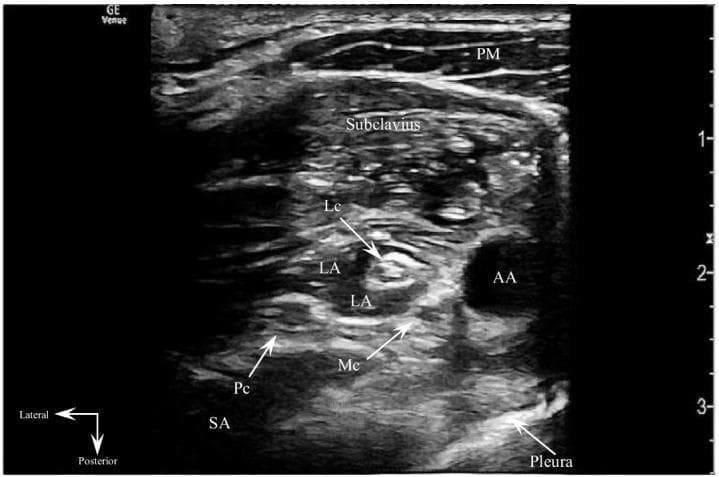This transverse sonogram depicts an ultrasound-guided costoclavicular brachial plexus block (CCBPB). The diagnostic image shows the anatomical relationships between muscular, vascular, and neural structures in the infraclavicular region. Superficially, the pectoralis major (PM) and subclavius muscles are visible. Centrally, the axillary artery (AA) appears as an anechoic circular structure. Surrounding the artery, the lateral (Lc), medial (Mc), and posterior (Pc) cords of the brachial plexus are identified by their hyperechoic fascicular patterns. Post-injection, anechoic local anesthetic (LA) is seen successfully infiltrating the costoclavicular space, effectively enveloping and hydrodissecting between the neural cords. The serratus anterior (SA) muscle is located posteriorly, while the pleura is visible as a distinct hyperechoic line in the deep field, serving as a critical safety landmark for the procedure. This image illustrates the regional anesthesia technique for providing analgesia or anesthesia to the upper extremity, emphasizing the importance of identifying the three cords clustered lateral to the axillary artery for a targeted block.