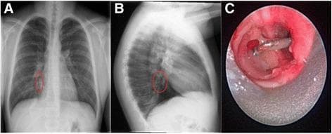 This composite figure illustrates a case of tracheobronchial foreign body aspiration and its secondary pulmonary complications. Panel A presents a posteroanterior (PA) chest x-ray showing a radio-opaque, vertically oriented metallic foreign body located in the right lower lobe bronchus, demarcated by a red circle. Panel B, a lateral chest x-ray, confirms the location of the metallic object and reveals focal airspace consolidation in the posterior basal segment, indicating secondary post-obstructive pneumonia. Panel C provides a bronchoscopic endoscopic view, demonstrating the impacted metallic foreign body within the bronchial lumen. The airway is significantly narrowed by surrounding erythematous, irregular granulation tissue and diffuse mucosal inflammation, representing a chronic inflammatory response to the foreign object. This educational material highlights the correlation between radiological findings (radio-opaque foreign body and consolidation) and direct endoscopic visualization of airway pathology including granulation and edema, relevant for pediatric pulmonology and otolaryngology.