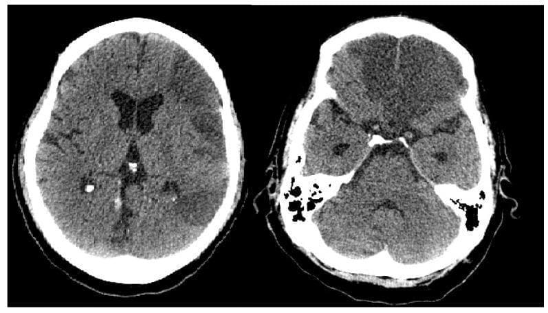 Two non-contrast axial CT images of the brain demonstrate a massive ischemic stroke. There is a prominent, well-demarcated area of hypoattenuation (decreased density) affecting the territory of the left middle cerebral artery and bilateral anterior cerebral arteries. Key anatomical features include a loss of gray-white matter differentiation and effacement of the cortical sulci in the affected regions, indicating significant cytotoxic edema. The ventricles are visible, though the left lateral ventricle shows signs of subtle compression due to the mass effect from the extensive infarction. The right hemisphere maintains relatively normal parenchymal density for comparison. This diagnostic imaging highlights the typical radiologic progression of a large-vessel occlusion and subsequent cerebral ischemia, essential for understanding vascular neurology and emergency stroke management.