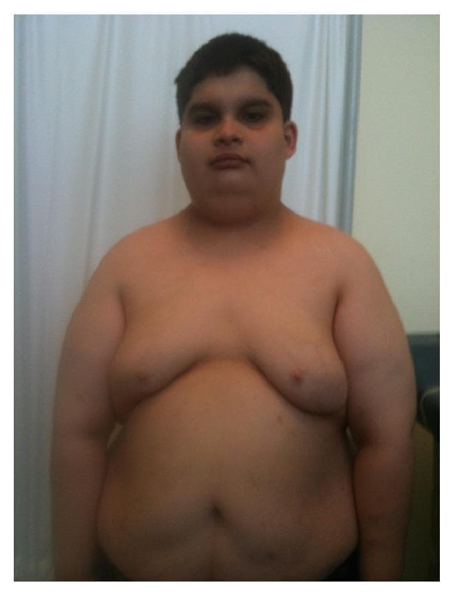 This clinical photograph shows the torso and head of a male teenager demonstrating the characteristic physical phenotype of Prader-Willi syndrome (PWS). Facial features include a narrow bifrontal diameter (narrow forehead), almond-shaped eyes with slightly upslanted palpebral fissures, and a thin upper lip. The body composition is characterized by generalized obesity with significant central (truncal) adiposity, notably involving the abdominal area and chest (gynecomastia or pseudogynecomastia). The skin appears fair. This visual presentation is educationally significant for medical students and clinicians as a textbook illustration of the dysmorphic features and metabolic manifestations (morbid obesity) associated with chromosomal deletions or uniparental disomy at the 15q11-q13 locus. Key educational concepts illustrated include phenotypic recognition of genetic obesity syndromes and dysmorphology assessment.