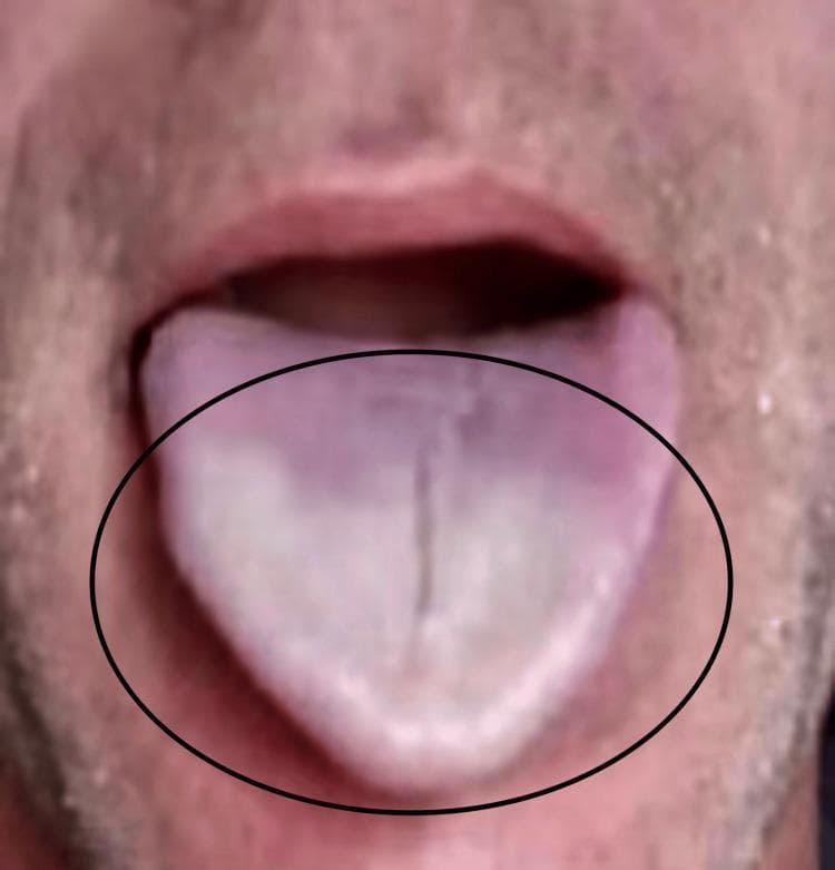 This clinical photograph displays a patient's protruding tongue, highlighting a rare intraoral manifestation of Raynaud's phenomenon. The image captures a sharp demarcation of color change: the distal one-third (the tip and lateral margins) exhibits a pale, blanching white appearance indicative of vasospastic ischemia. In contrast, the proximal portion of the tongue shows a dusky, purplish-blue cyanotic hue. The surface morphology is relatively smooth with a prominent midline longitudinal fissure visible within the ischemic zone. This visual demonstrates the classic triphasic or biphasic color changes associated with vasospasmβpallor followed by cyanosisβapplied here to the lingual vasculature. This educational resource is highly relevant for rheumatology and internal medicine, illustrating that Raynaud's phenomenon can occur in atypical anatomical locations beyond the digits, often triggered by cold exposure or emotional stress.