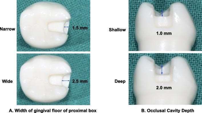 Educational comparison of dental cavity preparation designs for an inlay on mandibular first molars. The image is divided into two sections showing occlusal and proximal views. Section A (left) demonstrates the 'Width of gingival floor of proximal box' in occlusal view, comparing a 'Narrow' preparation (1.5 mm mesio-distal width) with a 'Wide' preparation (2.5 mm mesio-distal width). Section B (right) illustrates 'Occlusal Cavity Depth' in proximal view, comparing a 'Shallow' preparation (1.0 mm depth from the occlusal surface) with a 'Deep' preparation (2.0 mm depth). The visual highlights key variables in restorative dentistry, specifically the mesio-occlusal (MO) proximal box dimensions and the depth of the occlusal isthmus. Precise blue arrows and numerical annotations quantify the anatomical modifications made to the artificial tooth structure. This diagram serves as a reference for clinical dental students and practitioners to understand how cavity dimensions are standardized for biomechanical and digital trueness studies.