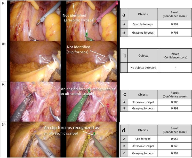 This composite educational image showcases four sets of intraoperative laparoscopic photographs (a-d) paired with AI detection results, illustrating challenges in automated surgical tool identification. The surgical field displays abdominal anatomy including yellow adipose tissue, reddish muscle fibers, and connective fascia. Row (a) demonstrates a spatula forceps and a grasping forceps, with one partially obscured grasping forceps labeled as 'Not identified'. Row (b) shows a clip forceps that failed detection, likely due to visual interference from shiny peritoneal surfaces. Row (c) depicts an angled forceps being misidentified as an ultrasonic scalpel, highlighting morphology-based classification errors. Row (d) features multiple overlapping instruments—a clip forceps, ultrasonic scalpel, and grasping forceps—where a single instrument is simultaneously identified as both a clip forceps and an ultrasonic scalpel. Accompanying tables provide confidence scores (ranging from 0.705 to 0.999) for the detected objects. This image serves as a clinical reference for computer-aided detection (CAD) limitations in laparoscopic surgery, specifically focusing on occlusion, instrument overlap, and morphological similarities between tools.