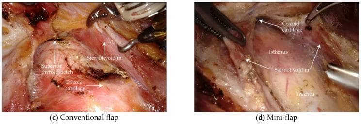 Two side-by-side intraoperative endoscopic photographs comparing conventional flap (left) and mini-flap (right) approaches during Bilateral Axillo-Breast Approach (BABA) thyroidectomy. The conventional flap image demonstrates a wider surgical exposure, with clear labeling of the superior thyroid notch, cricoid cartilage, and sternohyoid muscle. In contrast, the mini-flap image shows a more restricted surgical field focused on the central neck, highlighting the cricoid cartilage, thyroid isthmus, sternohyoid muscle, and the underlying trachea. Both images show robotic surgical instruments (forceps and retractors) positioned within the surgical plane for tissue manipulation. These images illustrate the differences in anatomical visualization and flap boundaries between the two techniques, emphasizing the reduced dissection area of the mini-flap approach while maintaining access to critical structures. The labels and visible landmarks serve to orient the viewer to the laryngeal and tracheal anatomy during the initial phase of endocrine surgery.