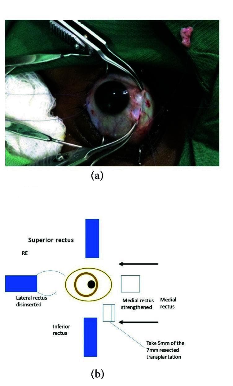 A composite image consisting of a clinical photograph and a schematic diagram illustrating a strabismus surgical procedure. Image (a) is a close-up clinical photograph of an intraoperative ophthalmological field showing the right eye. Two surgical forceps are retracting tissue and muscle, while 6-0 double-ended Vicryl sutures are visible within the moist, erythematous surgical site. A small portion of resected extraocular muscle tissue is seen on the green sterile drape in the top right. Image (b) is an anatomical schematic of the right eye (RE) detailing the surgical plan. It labels the superior, inferior, and medial rectus muscles. The diagram indicates a 'disinserted' lateral rectus and a 'strengthened' medial rectus, with specific instructions for a 5mm graft from a 7mm resected muscle transplantation. The content demonstrates complex extraocular muscle repositioning or transpositioning techniques used in corrective ophthalmic surgery for ocular motility disorders.