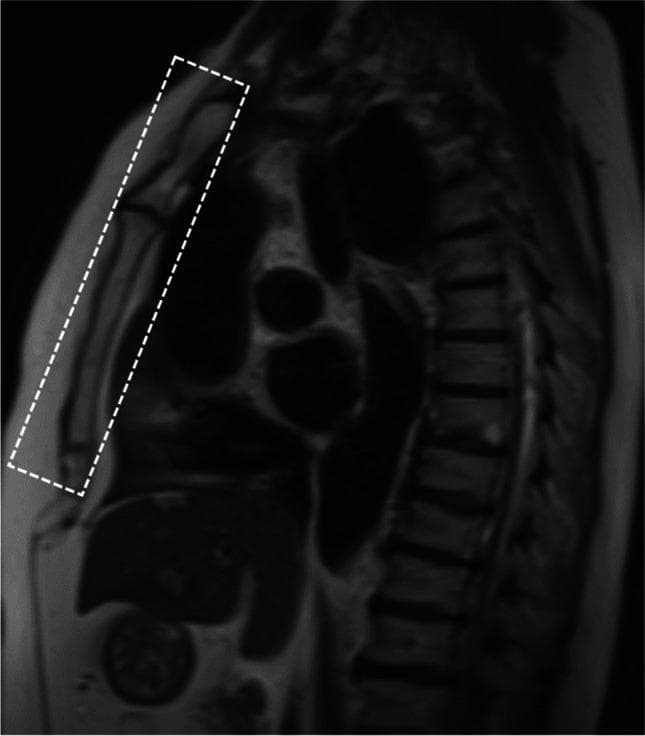 This diagnostic image is a magnetic resonance imaging (MRI) scan of the thoracic region, presented in a coronal oblique orientation. The plane of the scan is specifically aligned parallel to the sternum to optimize the visualization of the anterior chest wall structures. Anatomical landmarks visible include the sternum and costal cartilages anteriorly (highlighted within a dashed rectangular box), the thoracic spine posteriorly, and the intercostal spaces. The signal intensity across the image reflects varying tissue densities: the bony structures of the vertebrae and ribs demonstrate low signal intensity (darker), while the soft tissues, including the costal cartilage and pectoral muscles, show intermediate signal intensity. This specific imaging protocol is utilized in clinical settings to evaluate chest wall trauma, specifically to detect costal cartilage fractures, dislocations, or inflammatory changes such as edema that may not be readily apparent on standard axial CT or plain radiographs.