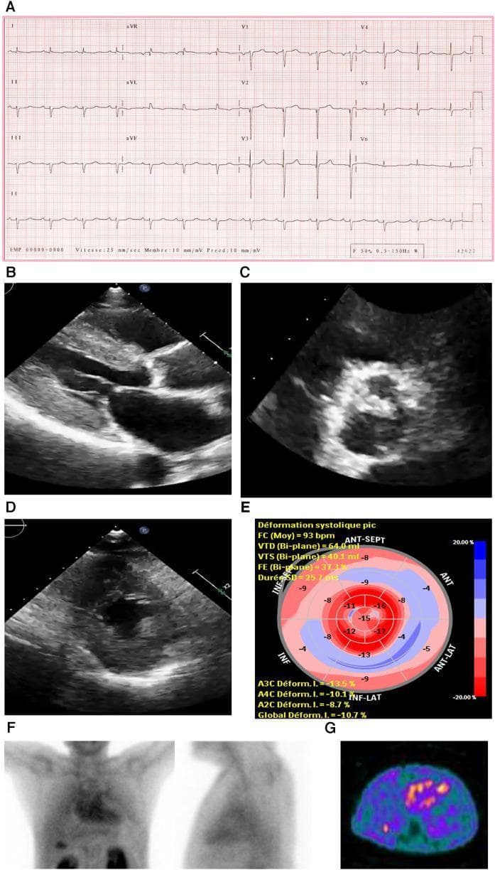 This composite diagnostic image illustrates clinical investigations for cardiac amyloidosis. Panel A shows a 12-lead electrocardiogram (ECG) demonstrating a regular sinus rhythm, prolonged PR interval (first-degree AV block), and low voltage in the limb leads, which contrasts with the ventricular hypertrophy seen in imaging. Panels B and D are 2D echocardiograms showing a small left ventricular (LV) cavity with marked concentric LV hypertrophy. Panel C displays a parasternal short-axis view of a severely calcified trileaflet aortic valve, characteristic of aortic stenosis. Panel E presents a global longitudinal strain (GLS) polar map ('bull's-eye' plot) showing reduced strain in the basal and mid-ventricular segments with relative apical sparing (a classic 'cherry on top' pattern). Panel F consists of anterior and lateral planar bone scintigraphy (99mTc-PYP) showing intense myocardial tracer uptake (Grade 3). Panel G shows a matching SPECT scan confirming strong cardiac uptake, confirming a diagnosis of transthyretin cardiac amyloidosis.