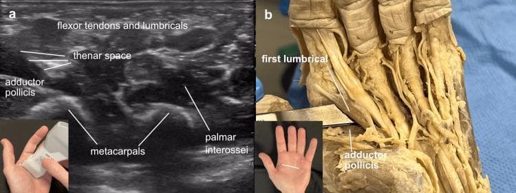 Educational comparison between musculoskeletal ultrasound (a) and cadaveric dissection (b) of the human hand, specifically focusing on the thenar space. Image (a) is a cross-sectional ultrasound of the left hand palm. It illustrates the adductor pollicis muscle as a hypoechoic (darker) deep structure, with the thenar space appearing as a dark potential space immediately superficial to it. Brighter, more echogenic (hyperechoic) structures superficial to the thenar space include the flexor tendons and the first lumbrical. Deeper landmarks include the hyperechoic boney contours of the metacarpals and the palmar interossei. Image (b) shows a corresponding cadaveric dissection where a surgical instrument is used for blunt dissection to enter the thenar space, located deep to the first lumbrical and superficial to the adductor pollicis muscle fibers. Insets show the ultrasound probe orientation and the anatomical site on a surface model. This visual is designed for orthopedic and radiological training to identify deep palmar spaces and muscular layers.