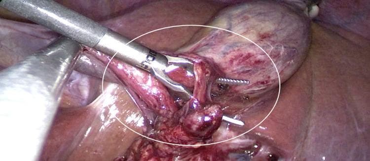 Laparoscopic surgical view demonstrating the dissection of the hepatocystic triangle (Calot's triangle) during a cholecystectomy in a patient with situs inversus totalis. The image shows the gallbladder, which appears erythematous with visible vascularity on its surface, positioned in the left hypochondrium (anatomical left). Within the white circle, a surgical grasper is manipulating the cystic duct and cystic artery to achieve the 'critical view of safety.' A white surgical clip is visible, having been applied to a tubular structure, presumably the cystic artery or duct, for ligation. The surgical field contains evidence of minor bleeding consistent with active tissue dissection. This image illustrates the 'mirror-image' surgical approach required for laparoscopic procedures in patients with total visceral transposition, where gallbladder removal is performed on the patient's left side rather than the standard right side.