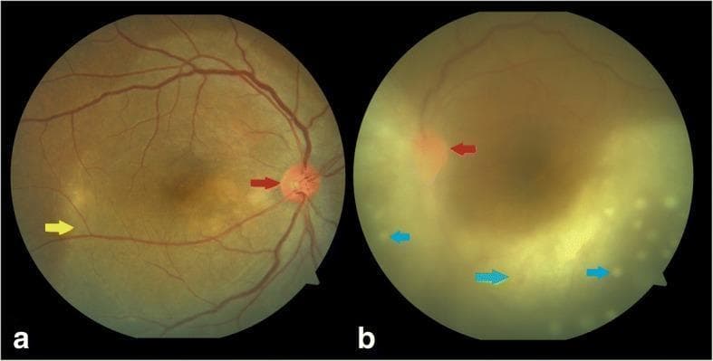This clinical imaging composite presents two color fundus photographs (a and b) illustrating ocular manifestations of ocular syphilis in a patient with HIV. Image (a) displays the right eye with a hyperemic optic disc (indicated by a red arrow) and a large, creamy-yellow, plaque-like lesion in the posterior pole consistent with posterior placoid retinochoroiditis (yellow arrow). The lesion exhibits a ground-glass appearance. Image (b) shows the left eye with significant media haze caused by dense vitritis (indicated by a green arrow), which obscures clear visualization of retinal details. Despite the haze, a hyperemic optic disc is visible (red arrow), along with multiple, small, punctate yellowish lesions scattered across the posterior pole, identified as superficial retinal precipitates (blue arrows). These clinical findings are characteristic of syphilitic uveitis and retinitis. The imagery demonstrates key diagnostic features including disc edema, active chorioretinitis, and inflammatory vitreous debris, which are critical for the clinical assessment of multi-system infectious diseases.