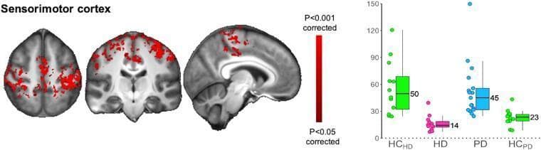 This composite educational graphic presents a comparison of functional connectivity in the sensorimotor cortex between patients with Huntington’s disease (HD) and Parkinson’s disease (PD). The left panel displays three orthogonal MRI views (axial, coronal, and sagittal) in radiological orientation, highlighting regions of interest in the sensorimotor cortex. Red-colored clusters indicate areas with statistically significant differences in functional connectivity (P < 0.05 to P < 0.001, corrected). The right panel features corresponding box plots showing parameter estimates (functional connectivity values) across four cohorts: healthy controls for HD (HCHD), HD patients, PD patients, and healthy controls for PD (HCPD). The data illustrates divergent pathological trends: HD carriers exhibit significantly lower functional connectivity (median = 14) compared to their controls (median = 50), whereas PD patients demonstrate higher functional connectivity (median = 45) compared to their matched controls (median = 23). Individual data points superimposed on the box plots indicate the variability within each group. This visual serves to teach the contrasting pathophysiology of sensorimotor network alterations in these two movement disorders.