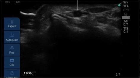 This diagnostic ultrasound image demonstrates a cross-sectional (short-axis) view of the radial artery at the wrist, captured during a vascular access procedure. The primary focus is the measurement of the arterial depth from the skin surface. The radial artery appears as a hypoechoic (dark), pulsatile circular structure surrounded by heterogeneous soft tissue. A vertical dotted caliper line extends from the epidermal surface to the superficial outer wall of the vessel. The measurement displayed in the lower-left corner (A 0.32 cm) quantifies this depth. Technical parameters are visible on the periphery, including a high-frequency linear (HFL) probe setting, a Mechanical Index (MI) of 0.7, and a Thermal Index (TIS) of 0.1. This visualization is essential for ultrasound-guided radial artery catheterization, helping the clinician determine the optimal angle of needle insertion and trajectory for successful cannulation. The image illustrates key landmarks in anesthesiology and vascular imaging, specifically focusing on superficial vascular anatomy and real-time procedural planning.