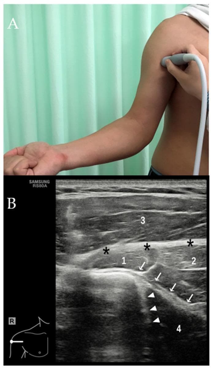 This composite educational resource comprises a clinical photograph and a labeled diagnostic ultrasound image focusing on the musculoskeletal anatomy of the shoulder and upper arm.
Image A (Clinical Photograph) demonstrates the procedural positioning required to evaluate the distal tendons of the latissimus dorsi (LD) and teres major (TM). The patient's arm is shown in maximal external rotation with a linear transducer placed transversely over the medial aspect of the proximal humerus.
Image B (Transverse Ultrasound) provides high-resolution imaging of the musculoskeletal structures. Key findings include the echogenic, linear fibrillar appearance of the LD tendon (white arrows) and the TM tendon (white arrowheads). The pectoralis major (PM) tendon is identified more superficially (black asterisks). Numbered annotations identify surrounding musculature: (1) biceps muscle, (2) coracobrachialis muscle, (3) deltoid muscle, and (4) LD muscle belly. The LD muscle belly appears markedly hypoechoic, representing a characteristic anisotropic artifact common in musculoskeletal US when the sound beam is not perpendicular to the muscle fibers. This visualization is essential for assessing tendon integrity in high-level athletes.