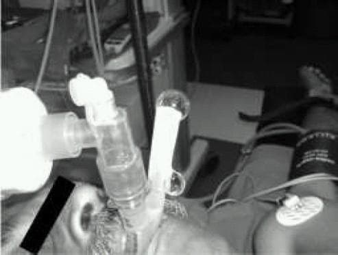 This clinical photograph demonstrates a ProSeal Laryngeal Mask Airway (PLMA) in situ on a patient, illustrating the 'gel displacement test' for airway seal evaluation. The airway management apparatus consists of a primary ventilation tube and a secondary, parallel gastric drain tube exiting the patient's mouth. In the image, a column of clear, water-soluble lubricant gel is visible within the proximal end of the gastric drain tube. The test is used to detect leaks; during positive pressure ventilation, the displacement or ejection of this gel column signifies an incompetent seal at the hypopharynx or malposition of the device's distal cuff. This procedural image highlights a critical bedside assessment technique in anesthesiology and emergency medicine to ensure correct supraglottic airway placement and the separation of respiratory and gastrointestinal tracts. The patient is also shown with standard monitoring equipment, including an ECG electrode and a blood pressure cuff.