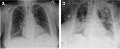 This diagnostic image set consists of two side-by-side anteroposterior (AP) chest X-rays labeled 'a' and 'b,' demonstrating a case of Transfusion-Related Acute Lung Injury (TRALI).
Image (a) represents the pre-transfusion baseline, showing relatively clear lung fields with normal lung volumes, distinct vascular markings, and a normal cardiac silhouette.
Image (b) depicts the post-transfusion state, showing significant pathological changes. Key findings include diffuse, bilateral, and heterogeneous airspace opacities (patchy and confluent densities) throughout both lung fields, consistent with acute pulmonary edema. There is a visible reduction in lung volumes compared to the baseline. Multiple medical support lines and monitoring leads are now present across the thoracic cavity, indicating an escalation in clinical care. The mediastinal and cardiac contours remain within normal limits, helping to distinguish this non-cardiogenic pulmonary edema from heart failure.
This comparison is an educational resource for identifying the radiological hallmarks of TRALI following blood product administration, emphasizing the rapid onset of bilateral pulmonary infiltrates.