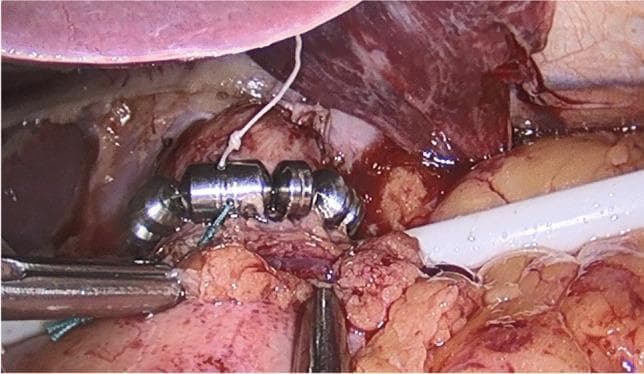 This clinical photograph captures a laparoscopic view of an implanted LINX Reflux Management System during a surgical procedure for Magnetic Sphincter Augmentation (MSA). The device, designed to treat Gastroesophageal Reflux Disease (GERD), consists of a series of cylindrical titanium beads with magnetic cores, interconnected by small wires to form an expandable annular ring. In the image, the bead chain is seen partially encircling the distal esophagus at the level of the lower esophageal sphincter (LES). Surgical instruments, including a laparoscopic grasper and a white retraction tool, are visible in the operative field, alongside a white suture tied to the device for positioning or fixation. The surrounding anatomy includes the liver retracted superiorly and the gastroesophageal junction. The photograph demonstrates the fundic-sparing nature of this anti-reflux surgery, illustrating the device's placement and the mechanical augmentation of the LES to prevent acid reflux while allowing bolus transit.