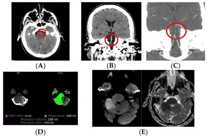 This composite diagnostic image illustrates a multimodal neuroimaging workup for acute ischemic stroke involving the posterior circulation in a 45-year-old male. Panels A (axial) and B (coronal) show non-contrast computed tomography (NCCT) scans demonstrating the 'hyperdense basilar artery sign' (red circles), a radiological marker of acute thrombus. Panel C provides a CT angiography (CTA) reconstruction confirming basilar artery occlusion. Panel D displays CT perfusion (CTP) mapping, showing a significant perfusion-diffusion mismatch: the green area represents tissue with delayed time-to-maximum (Tmax > 6.0s, 288 mL) versus a negligible infarct core (CBF < 30%, 0 mL), indicating a large salvageable penumbra. Panel E concludes with MRI sequences, where Diffusion-Weighted Imaging (DWI) and the Apparent Diffusion Coefficient (ADC) map reveal restricted diffusion in the right cerebellar region, confirming acute infarction. This series emphasizes the clinical utility of combining NCCT, CTA, CTP, and MRI in evaluating large vessel occlusions and determining treatment eligibility for reperfusion therapy.